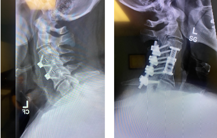 Javier's spine before and after treatment from Dr. Verma