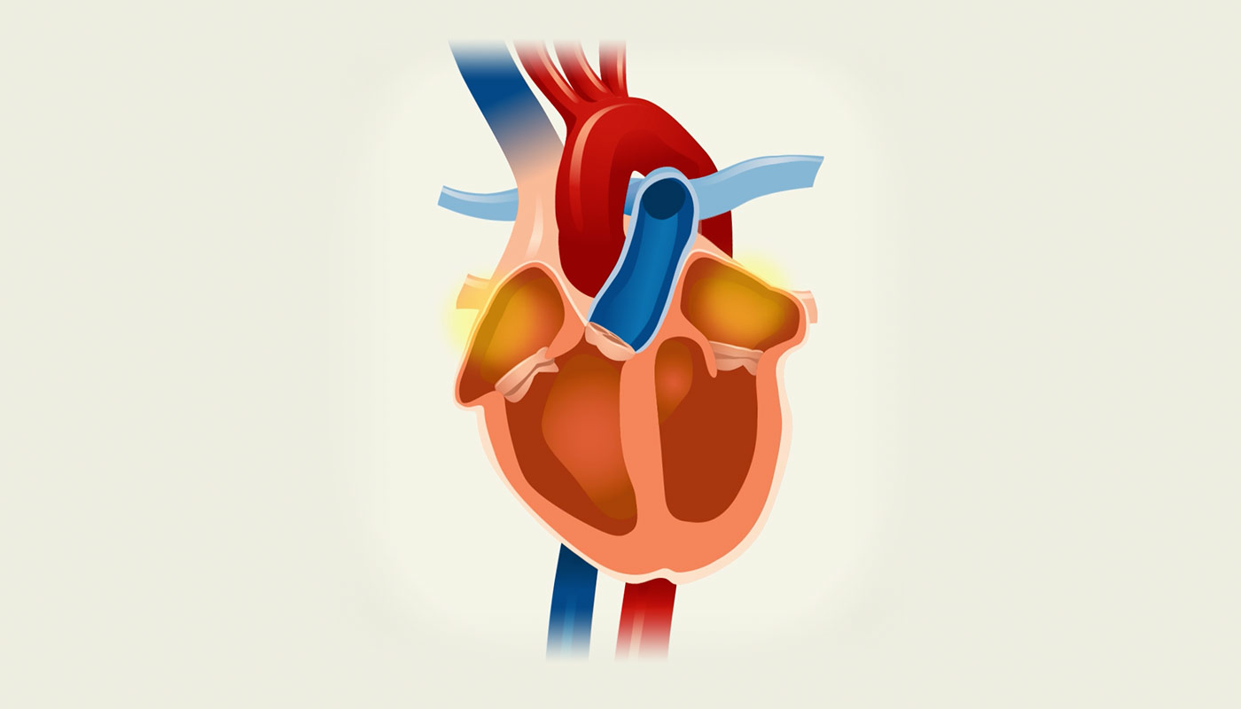 Occurs when faulty electrical signals cause the top chambers of the heart (atria) to beat very quickly and irregularly.