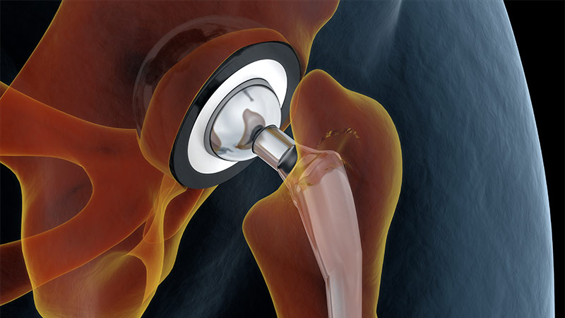 Joint Replacement Center